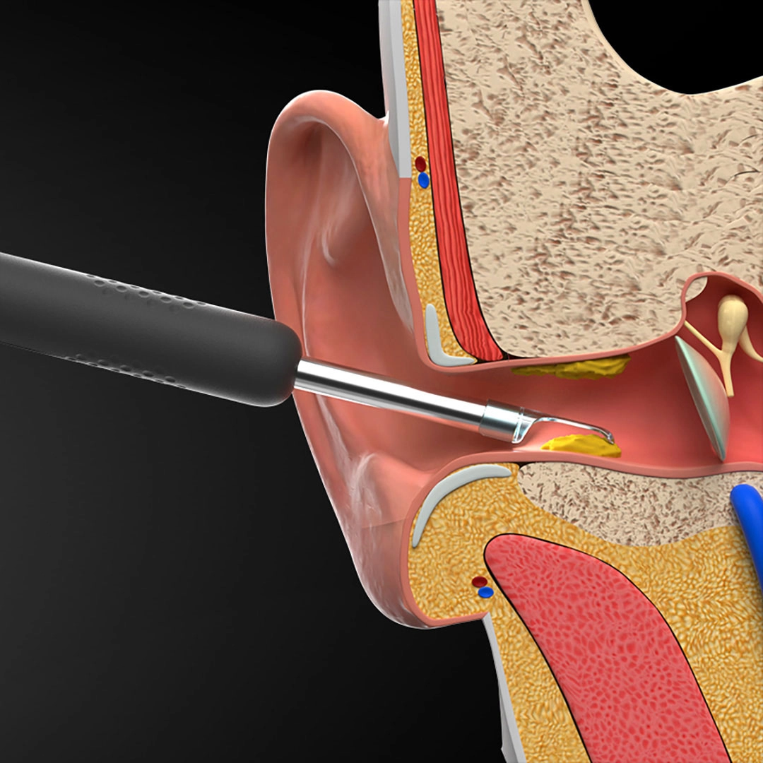 Dụng cụ lấy ráy tai thông minh Xiaomi Bebird R1 Dụng cụ lấy ráy tai thông minh Xiaomi Bebird R1